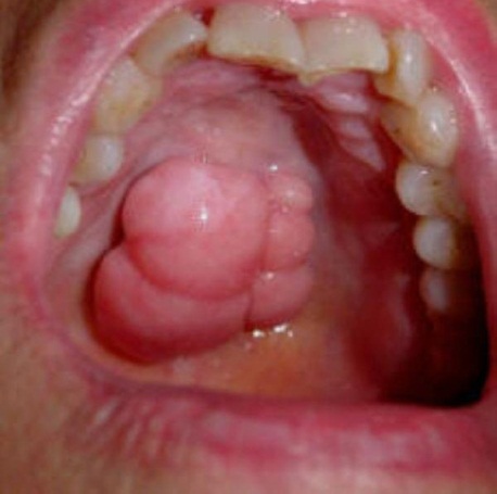 Throat Cancer Symptoms Throat Cancer Symptoms