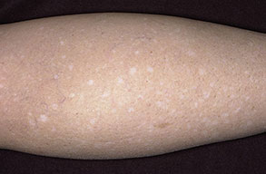 hypomelanosis idiopathic guttate causes white spots on skin