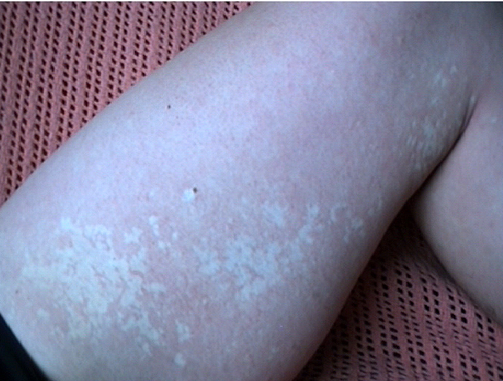 nevus depigmentosus causes white spots on skin