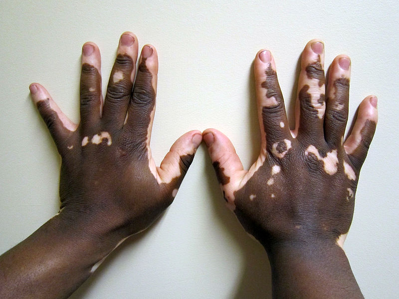vitiligo causes white spots on skin
